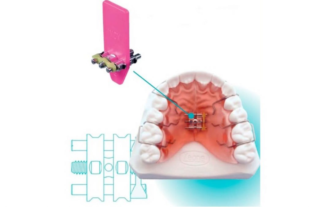 Застосування гвинтів у практиці ортодонту